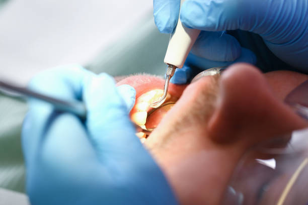 Best Emergency Dental Care for Broken or Chipped Teeth in Noblesville, IN